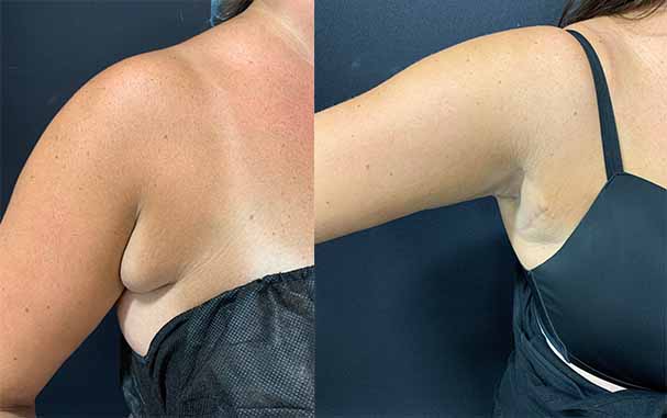 BA-FEMALE-ARMPIT-LIPOSUCTION_10.23.2019.